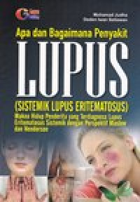 Image of Apa dan Bagaimana Penyakit LUPUS (Sistemik Lupus Eritematosus)